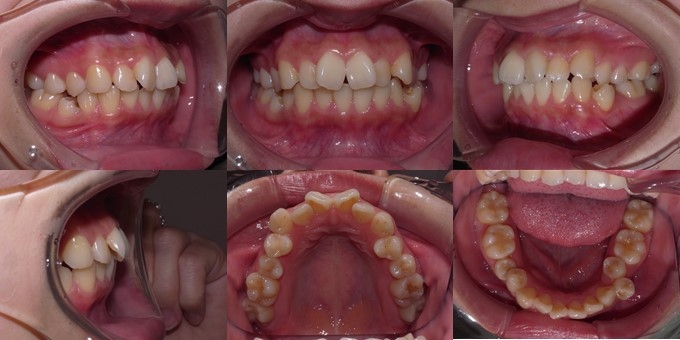 叢生について 歯並びがデコボコ