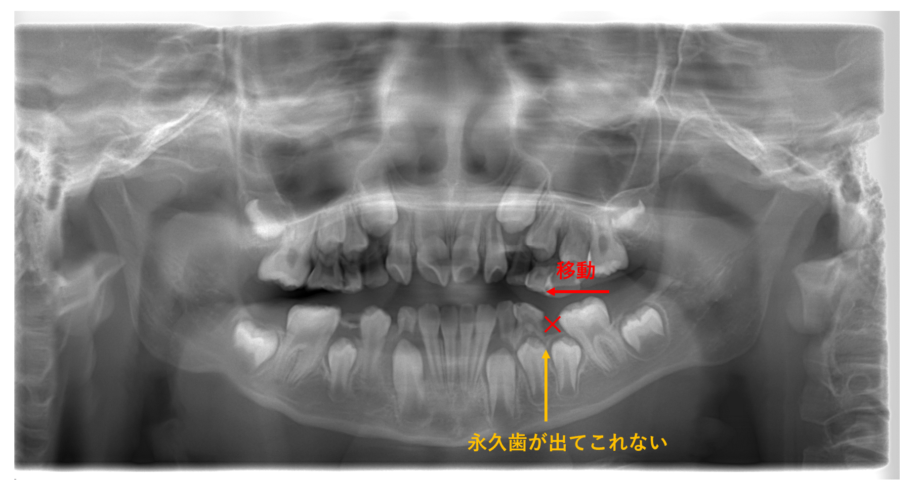 早期脱落